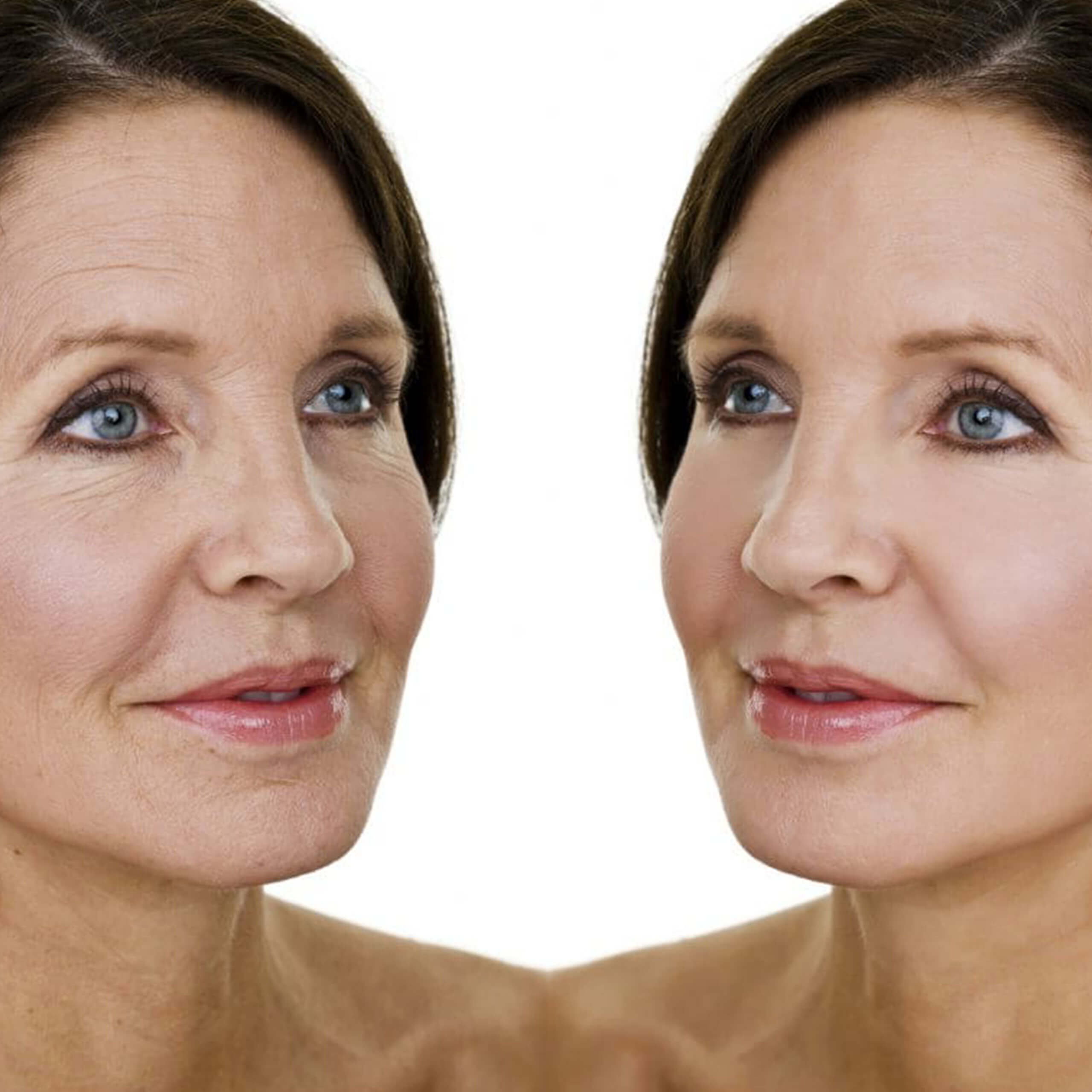 Facelift - Rhytidectomy Facelift - Rhytidectomy