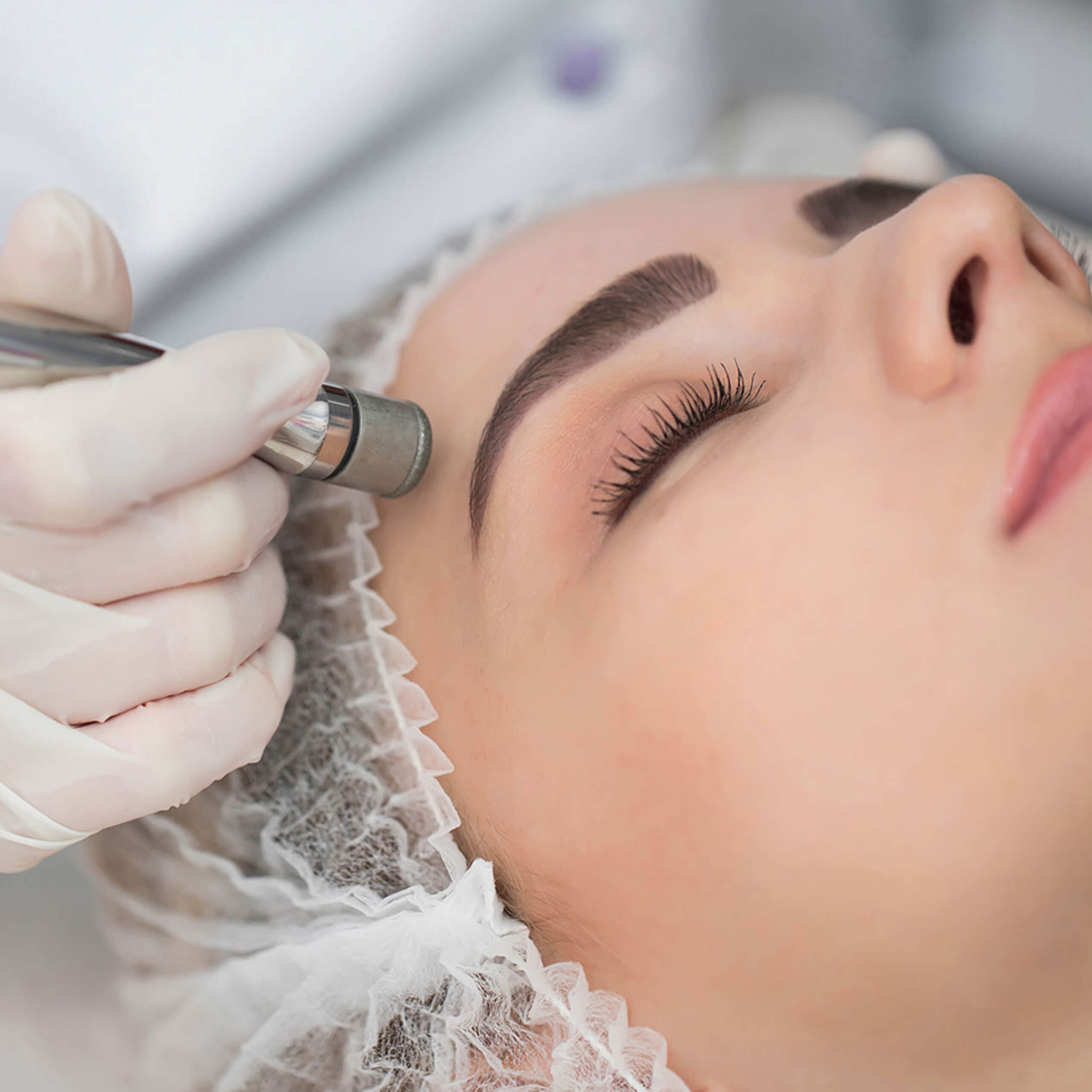 Microdermabrasion Microdermabrasion