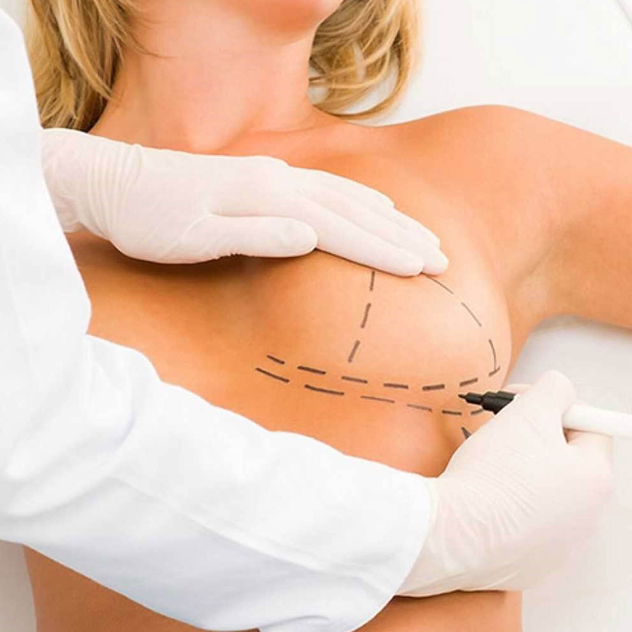Breast Lift
Mastopexy Breast Lift - Mastopexy
