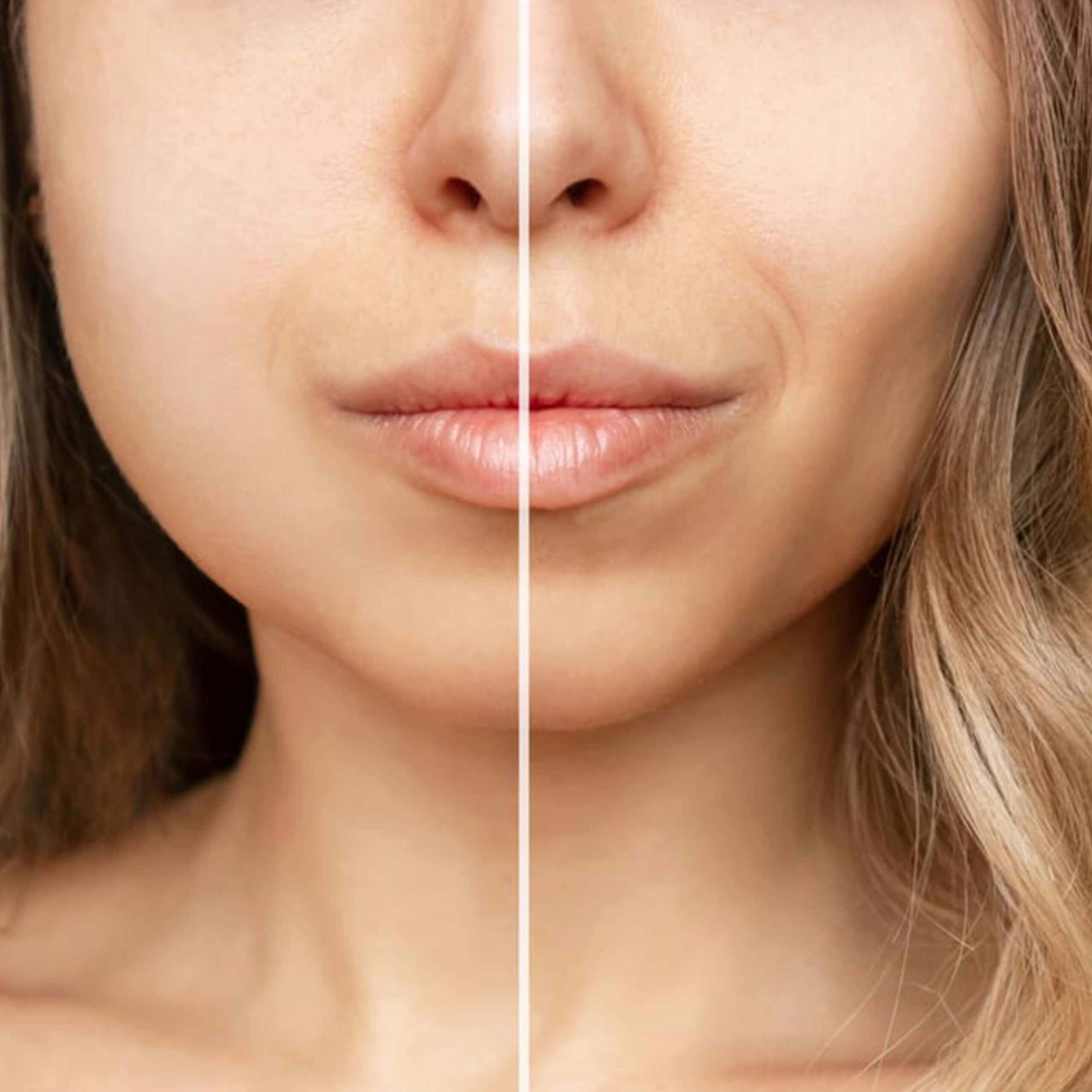 Buccal Fat Removal - Bichectomy Buccal Fat Removal - Bichectomy