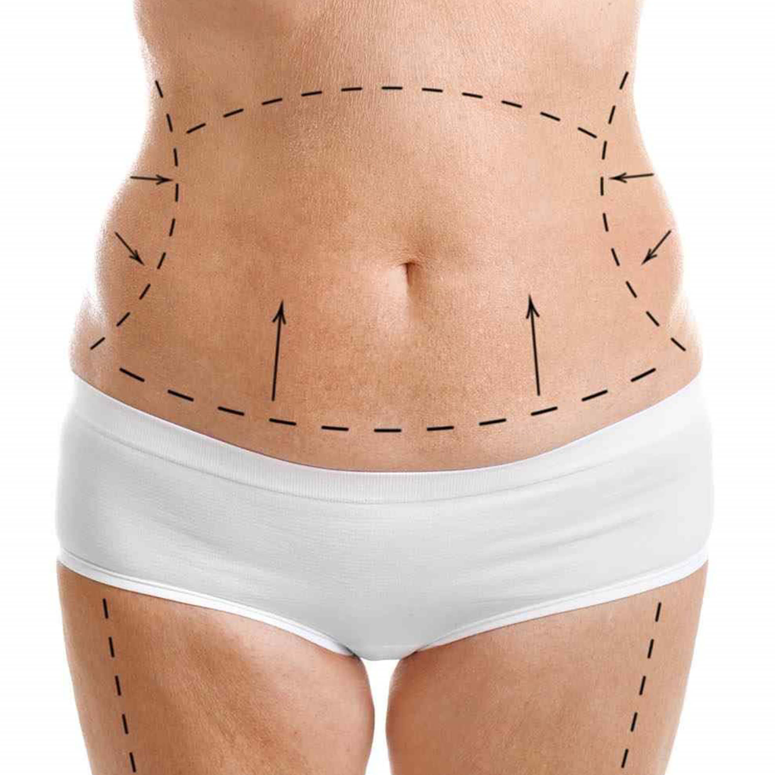 Tummy Tuck Tummy Tuck