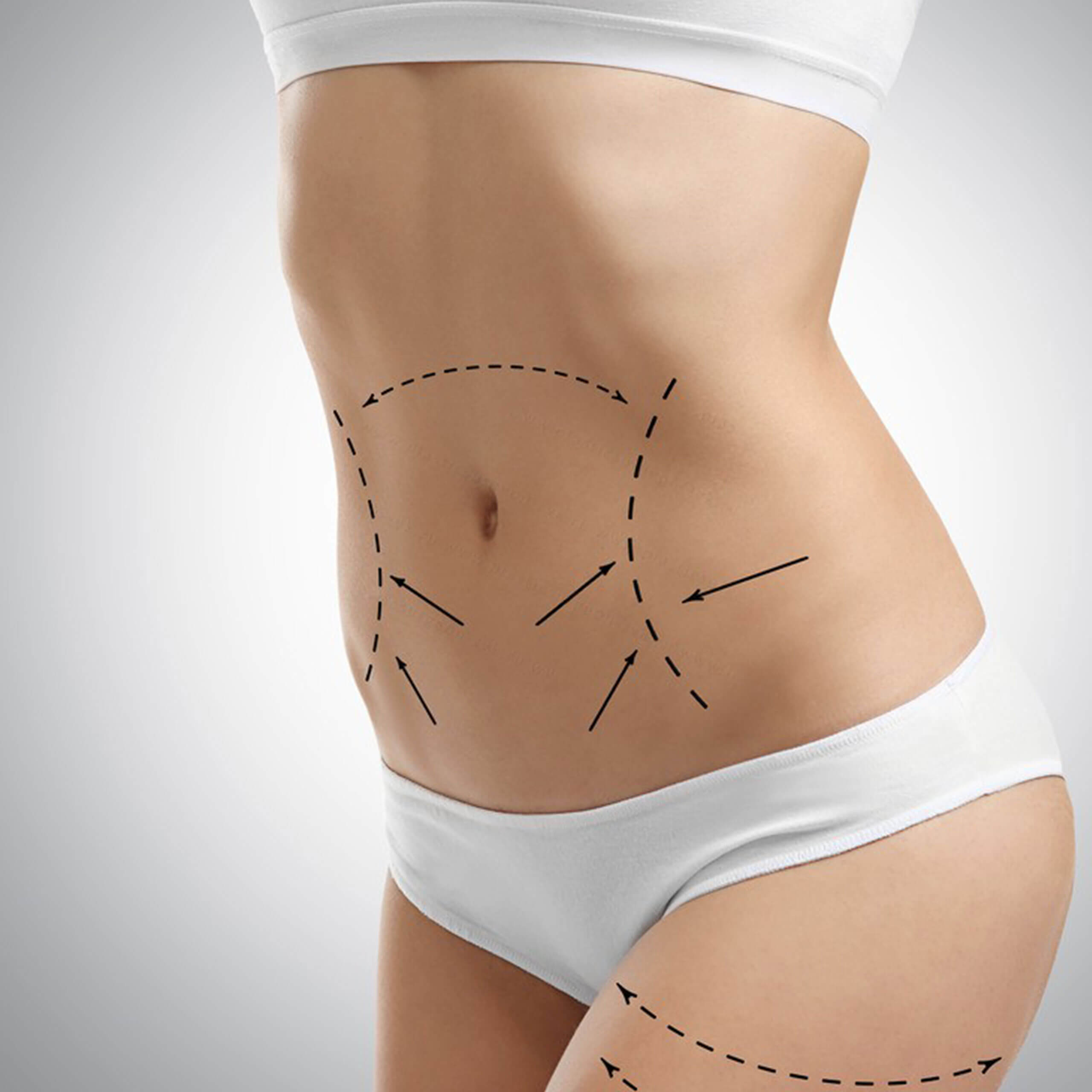 Abdominoplastía Abdominoplastia