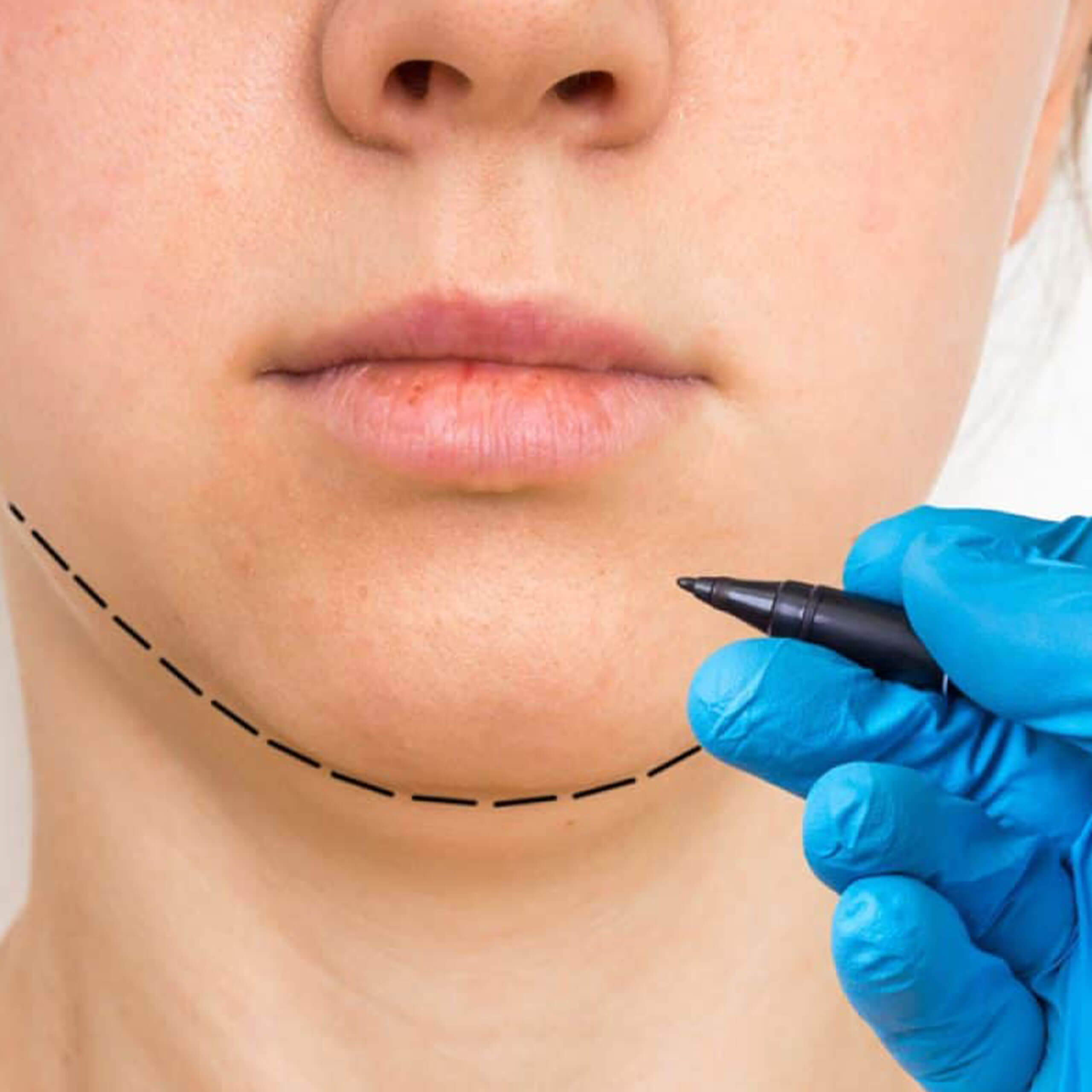 Mentoplastia Mentoplastia