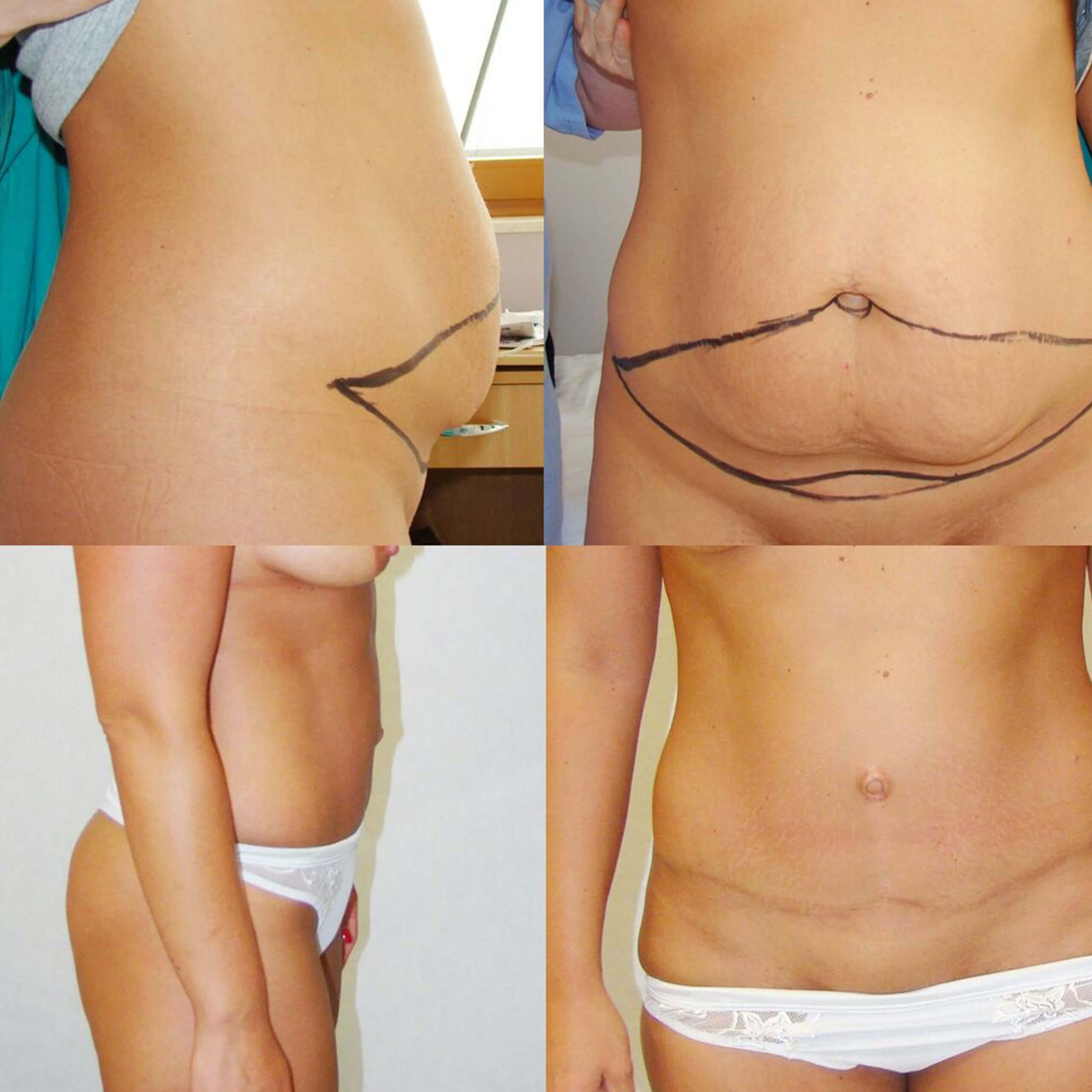 Mommy Makeover Mommy Makeover