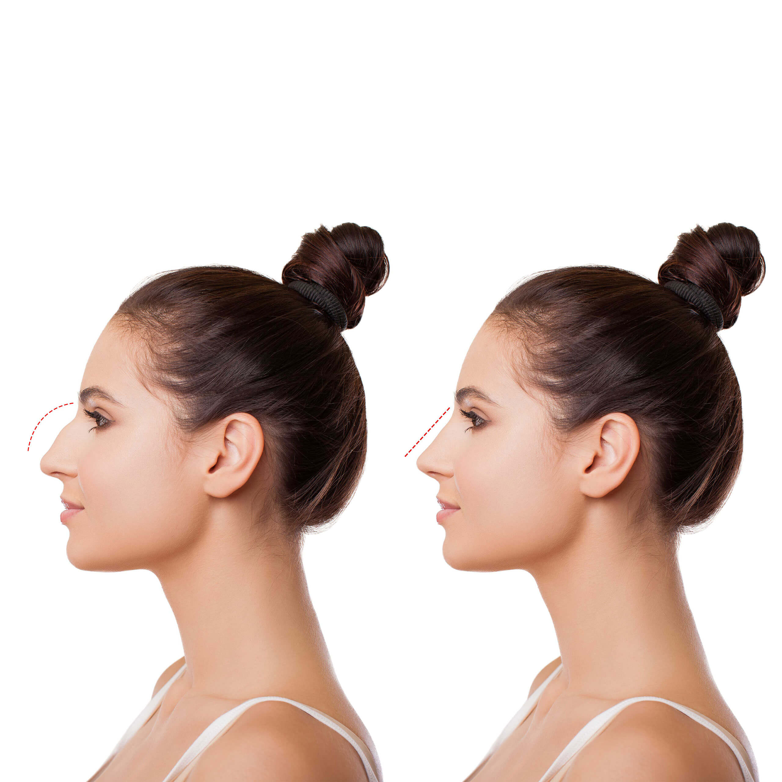 Rinomodelación Rinomodelación